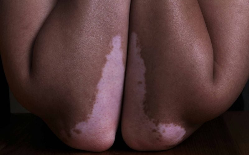 Signs of skin cancer risks illustrated by pigmentation changes on legs.