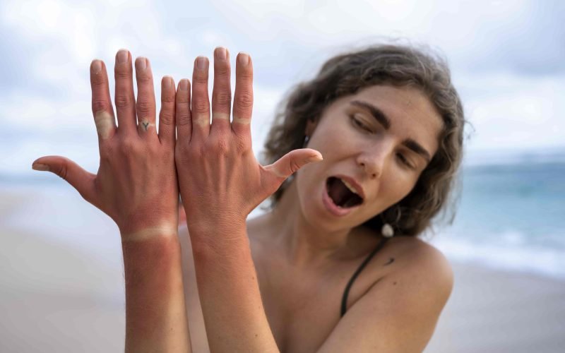 Beach skin care essential: Woman shows sunburn on hands, a reminder to use sun protection.