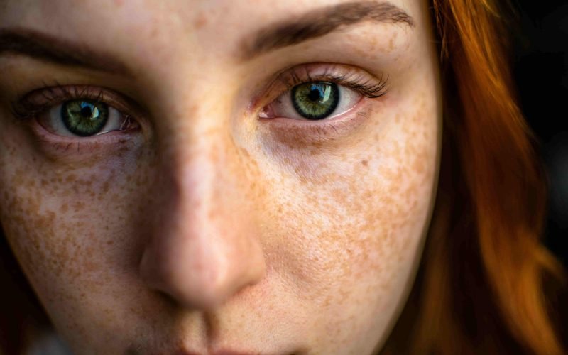 Close-up of a woman's face showing freckles, illustrating the question, "Do skin care products cause cancer?"